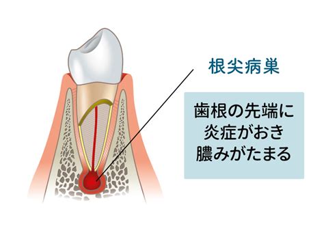 病巢 意味|「病巣」の意味や使い方 わかりやすく解説 Weblio辞書